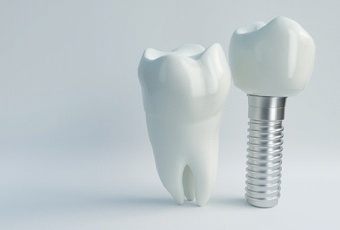 dental implant with crown next to natural tooth