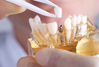 Image result for dental implant dentist