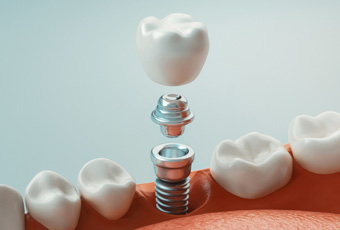 A 3D rendering of a single dental implant post and crown