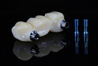 A closeup of a dental implant bridge and its posts