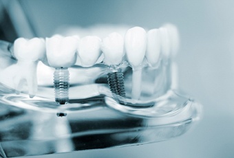Dental implants in plastic model of mouth