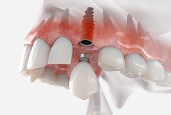 Illustration of dental crown being placed on dental implant in upper jaw