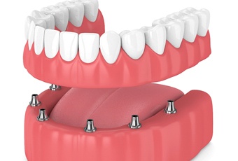 Illustration of implant dentures for lower arch against white background