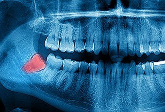 X-ray with wisdom tooth highlighted