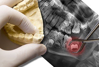 X-ray and model of wisdom teeth
