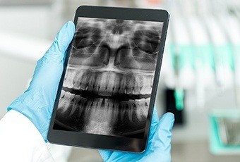 Digital dental x-rays