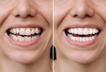 Closeup of woman's smile before and after veneers