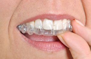 invisalign ripon