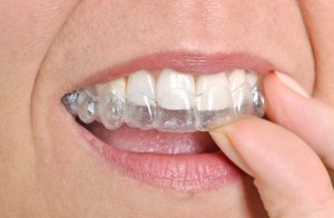 invisalign ripon