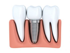 Learn more about how Oshkosh dental implants can restore your smile and your confidence.