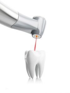 Dental laser and tooth