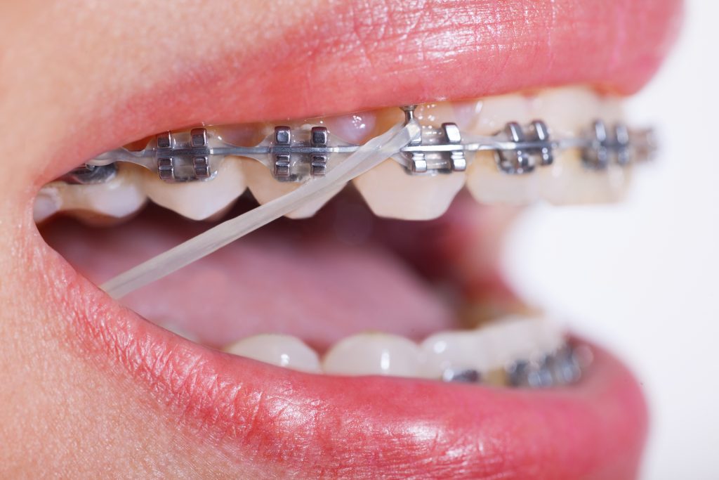 Up-close of rubber band on braces