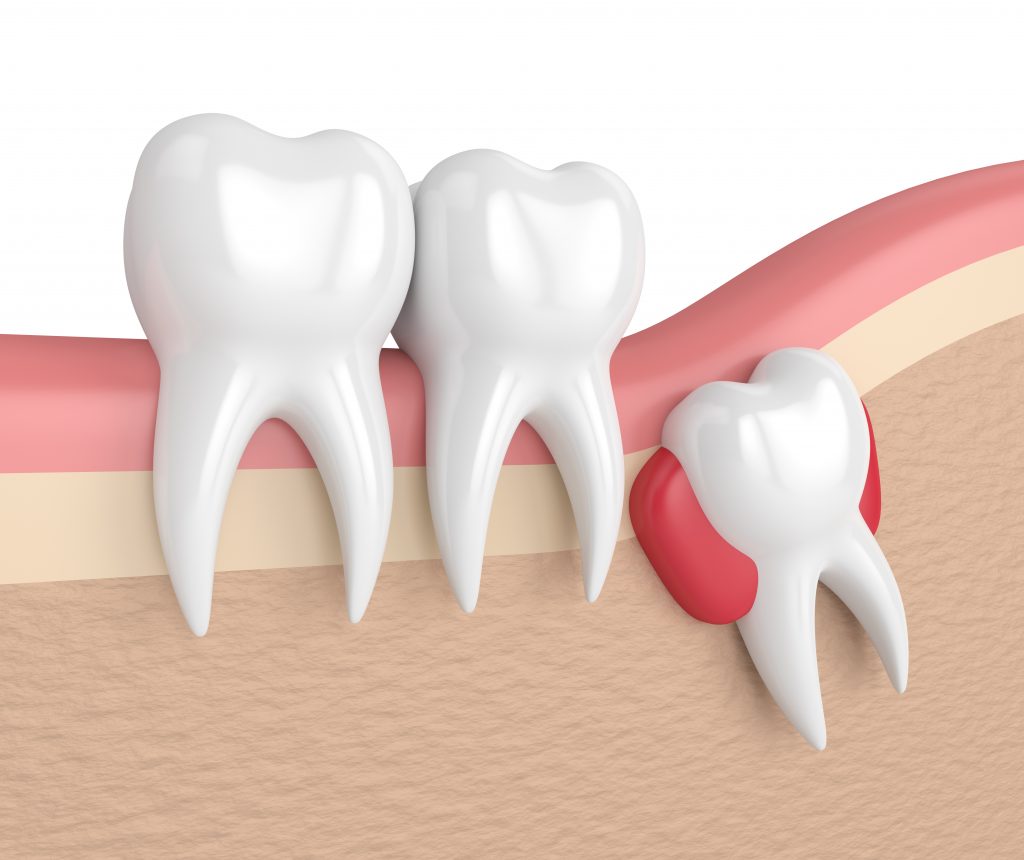 3D model of an impacted wisdom tooth 