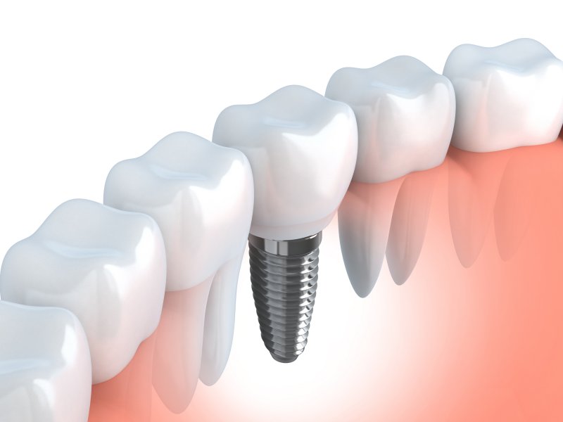 Illustration of a dental implant between natural teeth