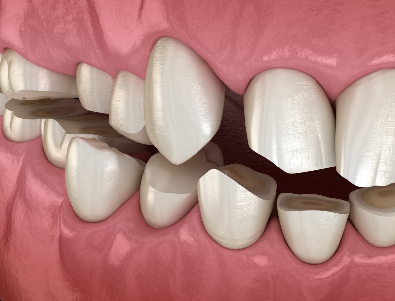 Model of mouth with eroded teeth