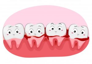 bleeding gums illustration