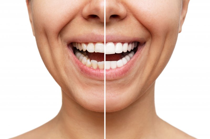 woman with veneers before and after 