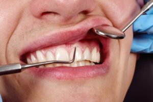 a patient smiling while their dentist inspects their gums