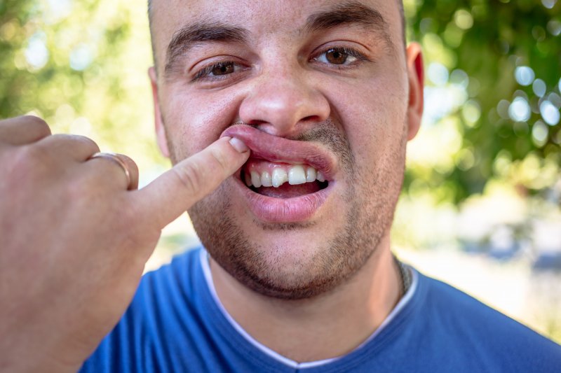 young man showing chipped tooth